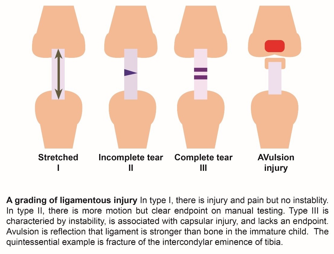 grading of ligamentous injury